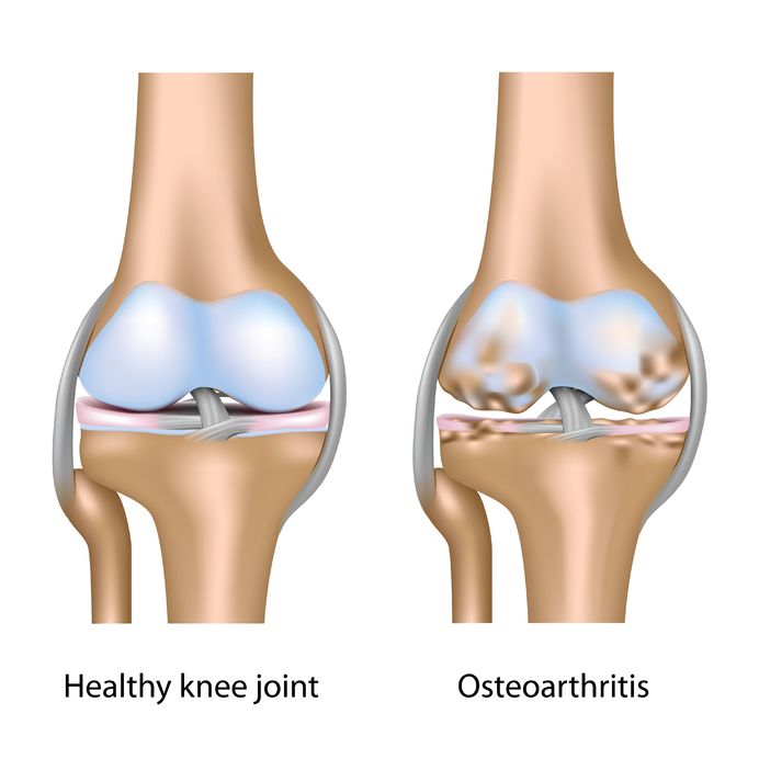 Early Osteoarthritis Treatment without Knee Replacement